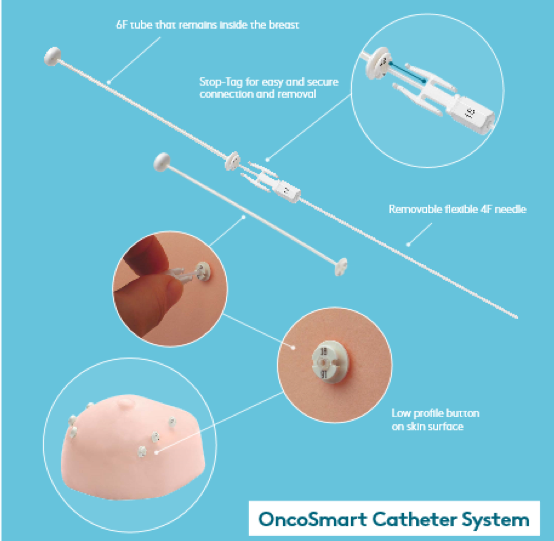 Oncosmart导管系统GydF4y2Ba